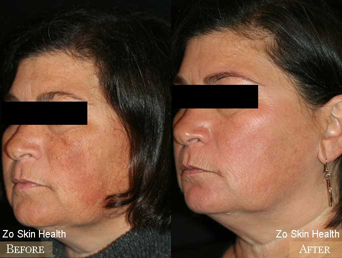 Zo Skin Health Before & After