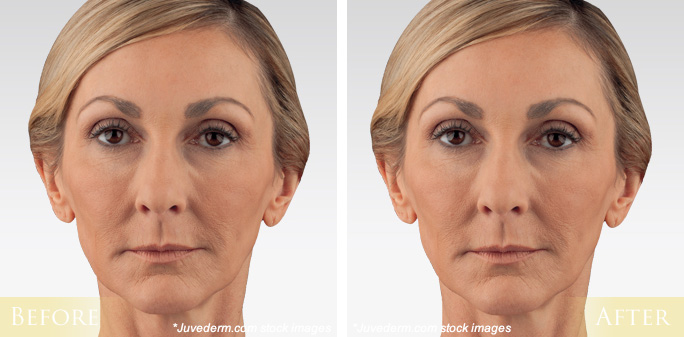 Juvederm Before & After