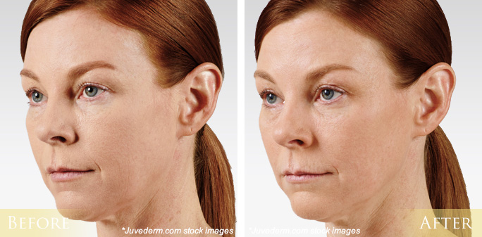 Juvederm Before & After