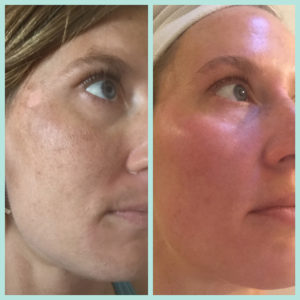 skinceuticals-peel-before-after-1