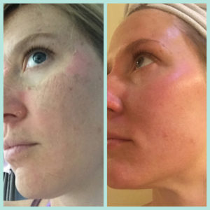 skinceuticals-peel-before-after-2