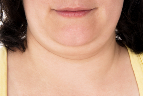 CoolSculpting double chin