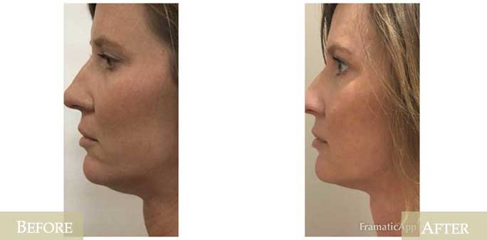Kybella Before & After