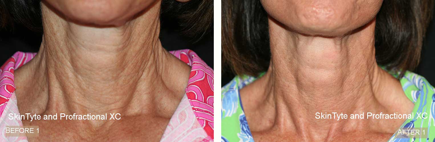 SkinTyte and Profractional XC Before & After
