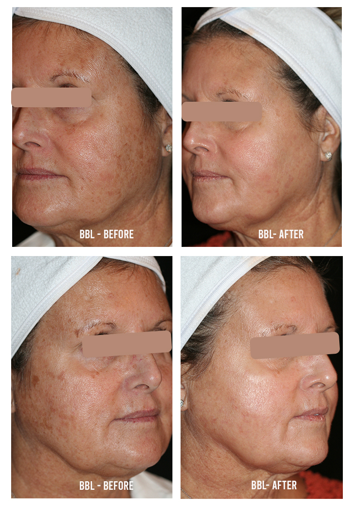 Bbl Skin Treatment Before And After Your Magazine Lite