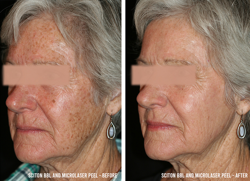 BBL® Laser Skin Rejuvenation Before and After Pictures Case 252, Toronto,  ON